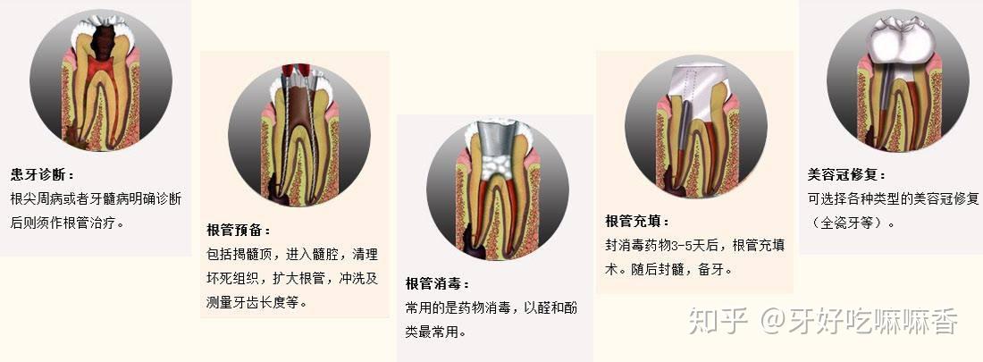 前沿技术引领下的全新一代根管治疗技术解析